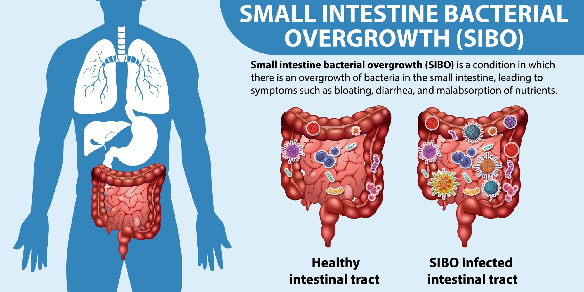 Demystifying SIBO for Functional Medicine Practitioners