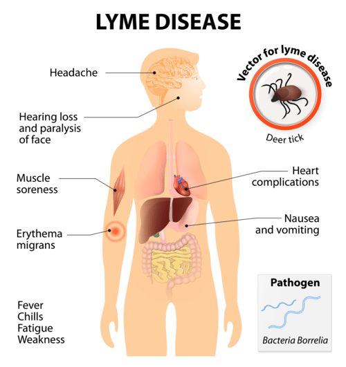 Lyme symptoms