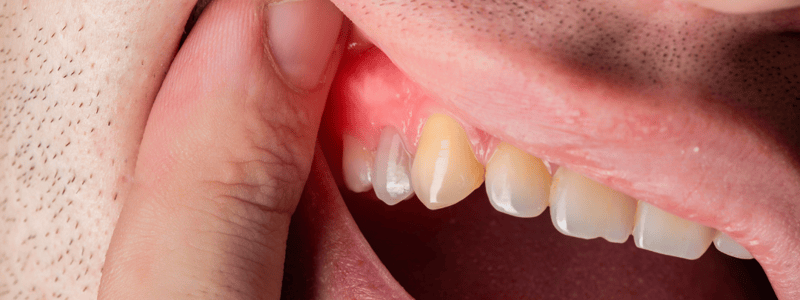 Periodontal Disease