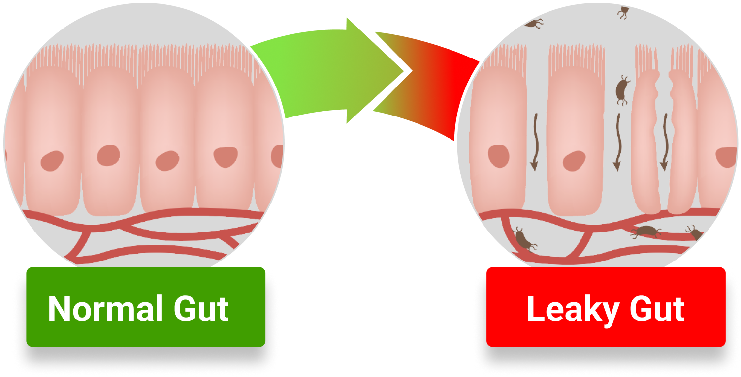 Graphic camparing "Normal Gut" (healthy) vs "Leaky Gut"