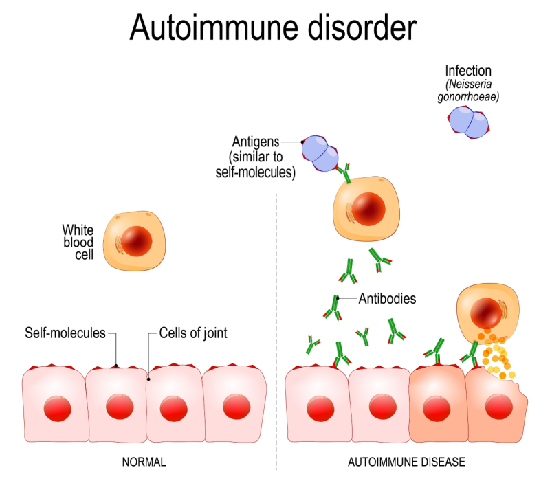 autoimmune diseases-1