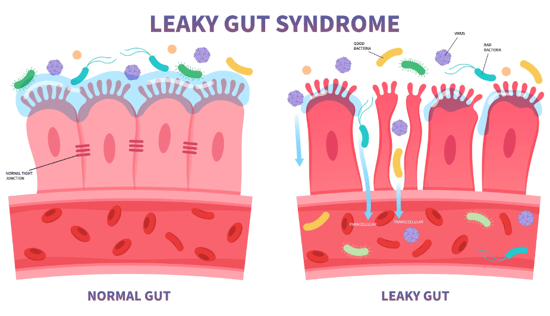 leaky gut resized 