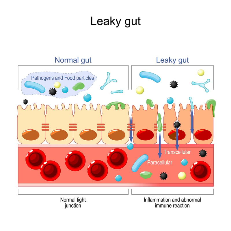 leaky gut